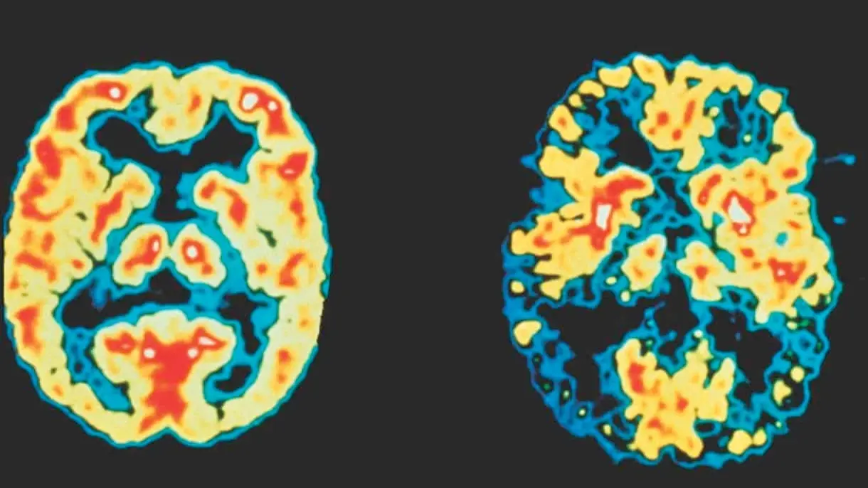 ارتفاع جسيمات البلاستيك في أدمغة مرضى الخرف بمعدل 5 أضعاف