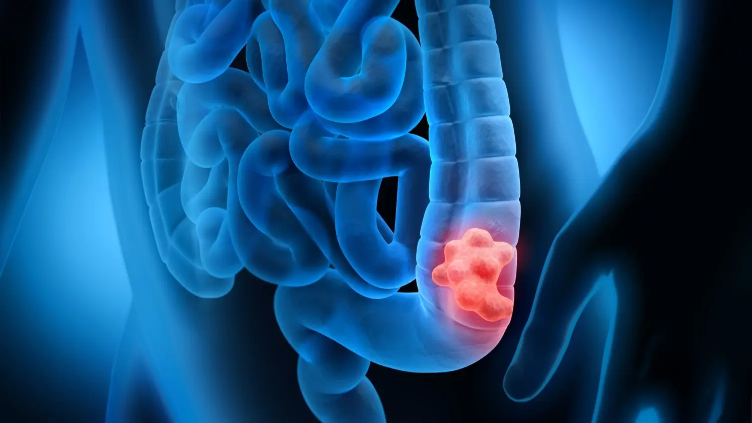 "تسونامي": سرطان الأمعاء يفتك بالشباب ويتربع على عرش الأمراض الفتاكة