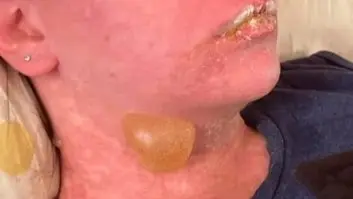 تحول دواء شائع إلى مأساة: آثار جانبية نادرة تشوه وجه امرأة